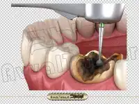 فایل png تصویر دوربری شده سه بعدی ترمیم دندان خراب