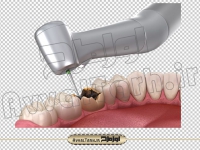 دانلود png تصویر دوربری شده سه بعدی پر کردن دندان