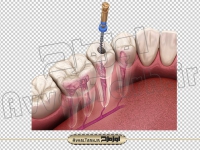 فایل png تصویر سه بعدی عصب کشی دندان